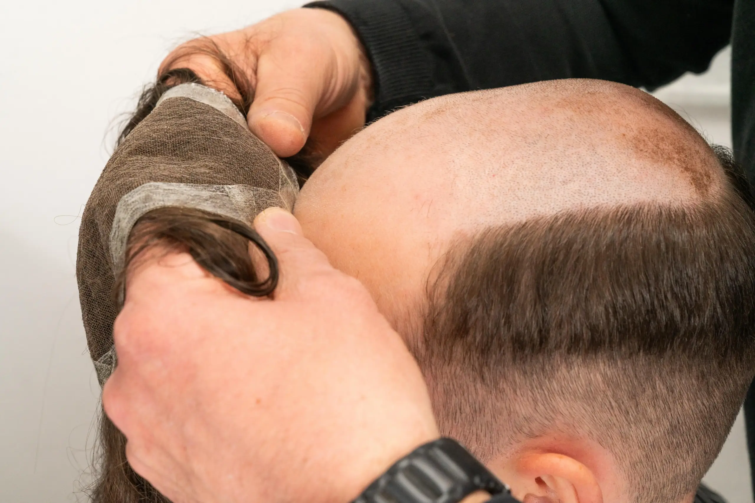 Vorher Haarsystem